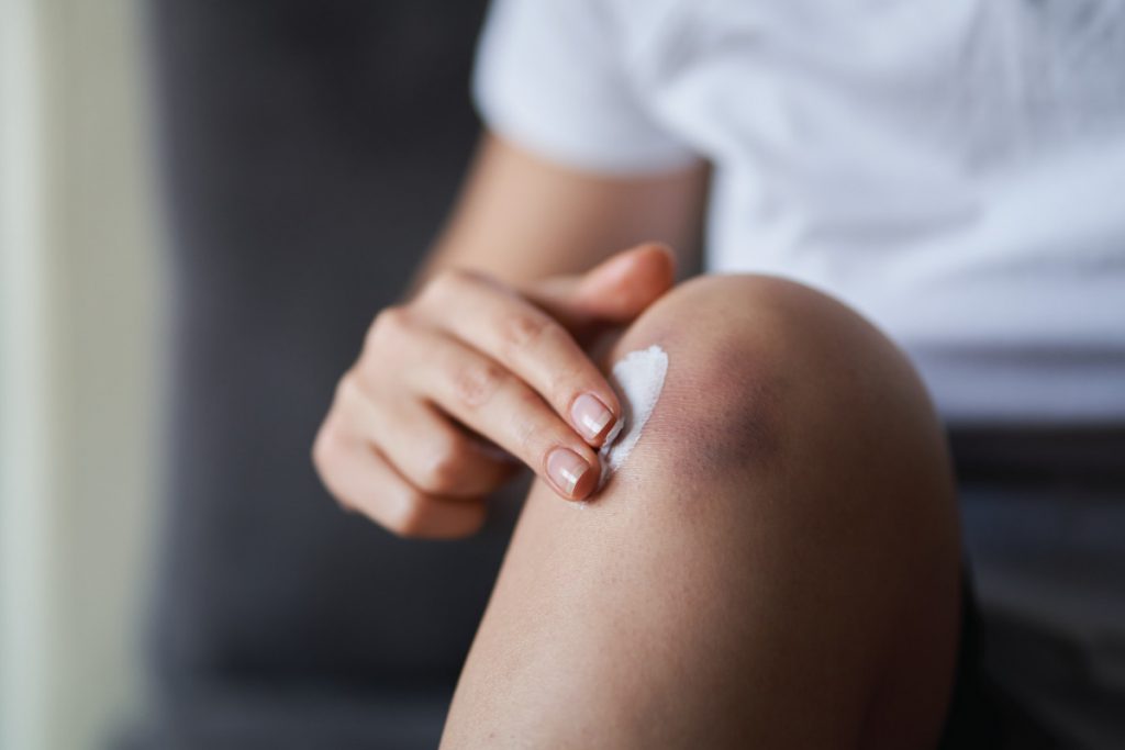 person applying arnica cream